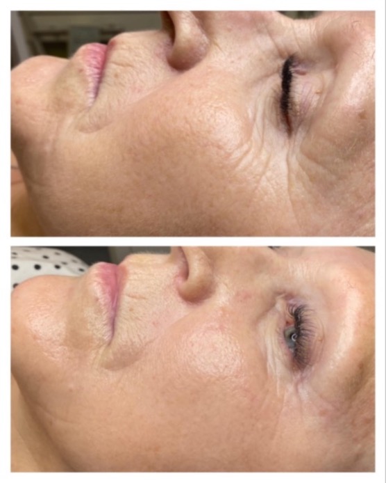 Amber Re-derm Exfoliliator - Кремовый пилинг с янтарной кислотой, 30 мл