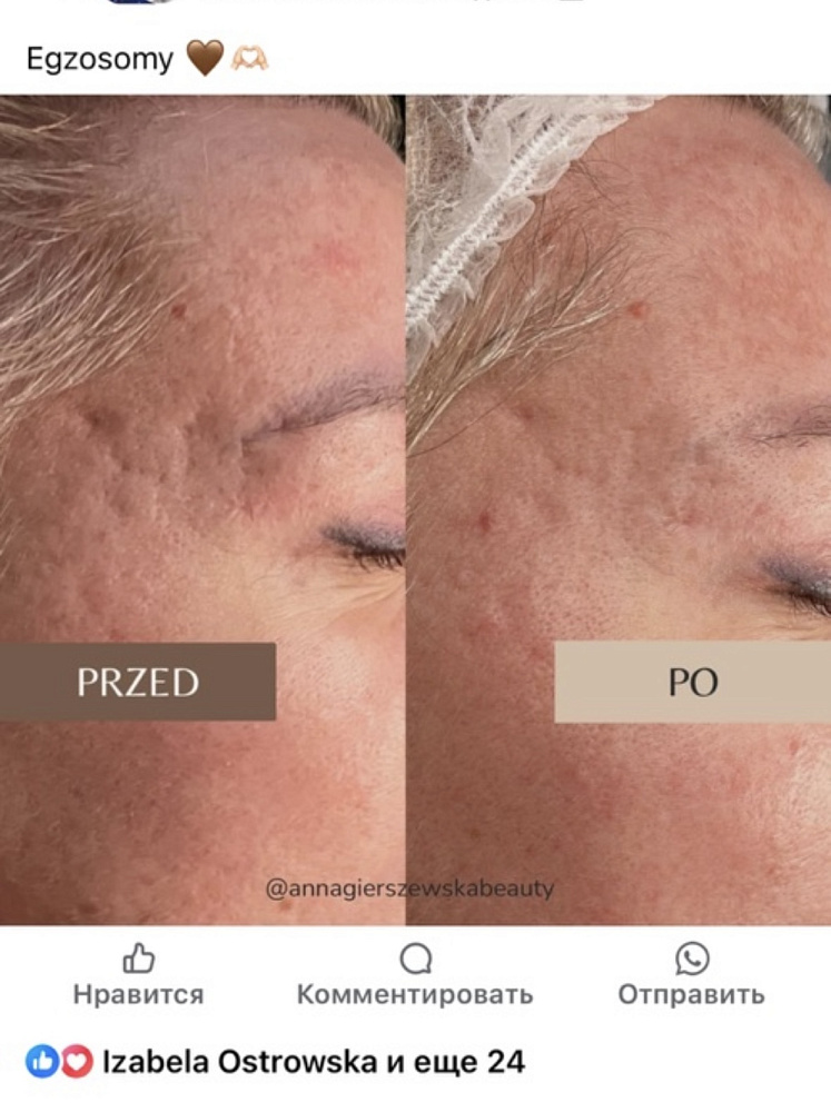EXO + PRP Advanced Therapy - Омолаживающая процедура для лица с экзосомами и пептидами, 2х3 мл