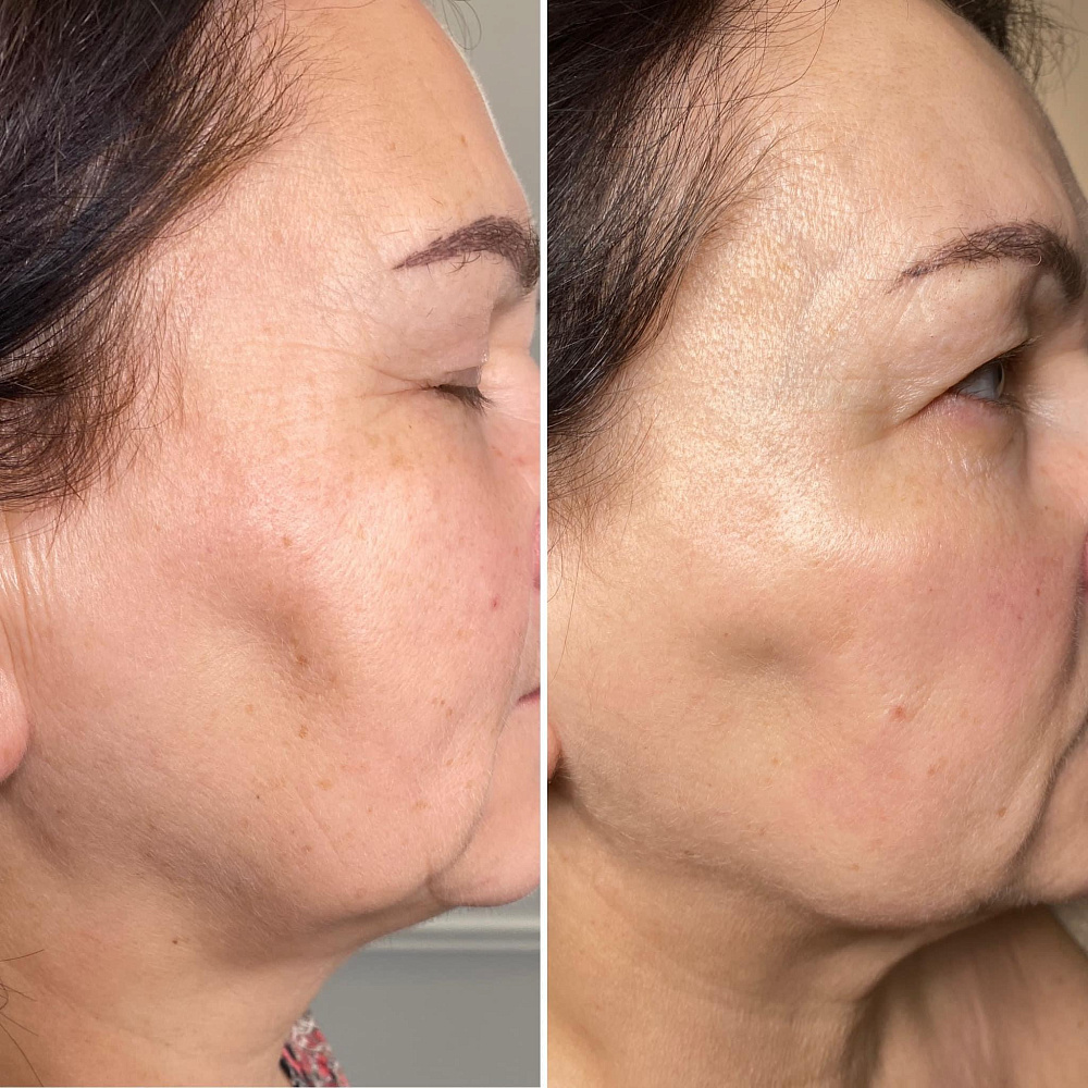 EXO + PRP Advanced Therapy - Омолаживающая процедура для лица с экзосомами и пептидами, 2х3 мл